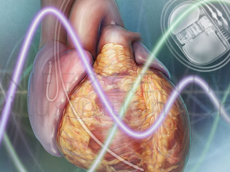 ICD and electromagnetic interference