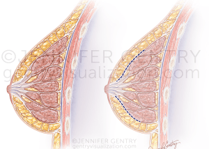 Breast Crossection Incision