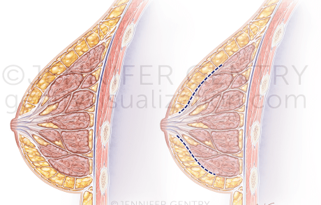 Breast Crossection Incision