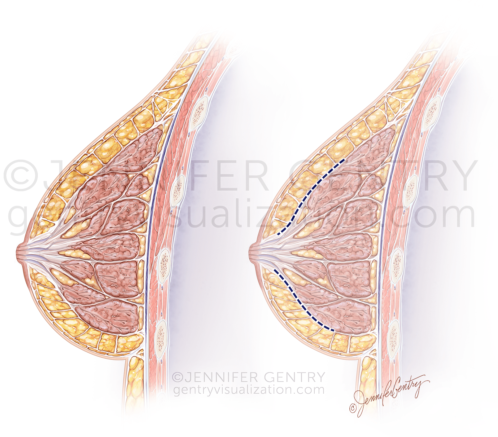 Breast Crossection Incision