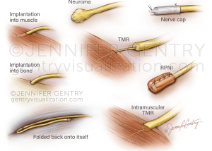 Nerve Repair Options