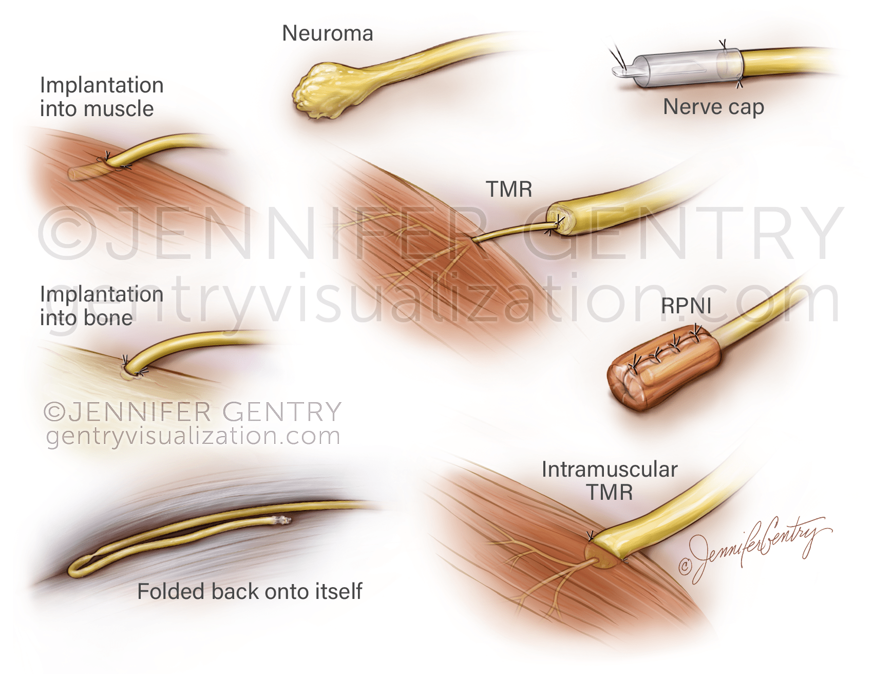 Nerve Repair Options