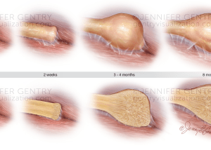 Neuroma development