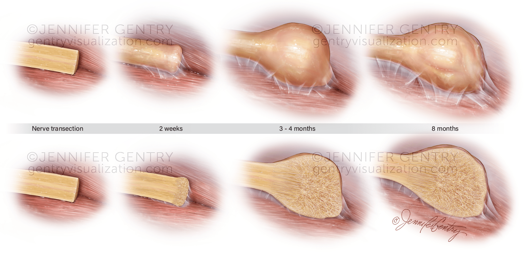 Neuroma development