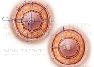 Wagon Wheel vs Purse String Areolaplasty