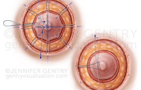 Wagon Wheel vs Purse String Areolaplasty