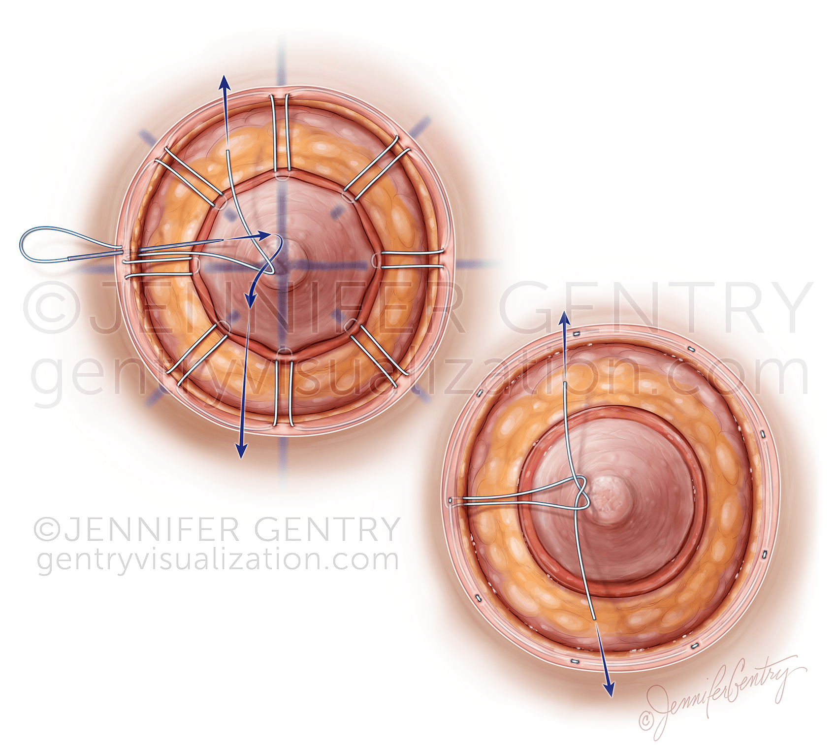 Wagon Wheel vs Purse String Areolaplasty