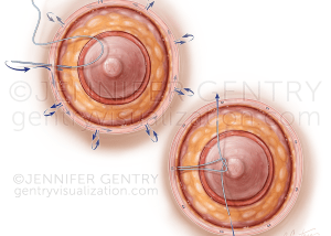 Purse String Areolaplasty