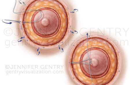 Purse String Areolaplasty