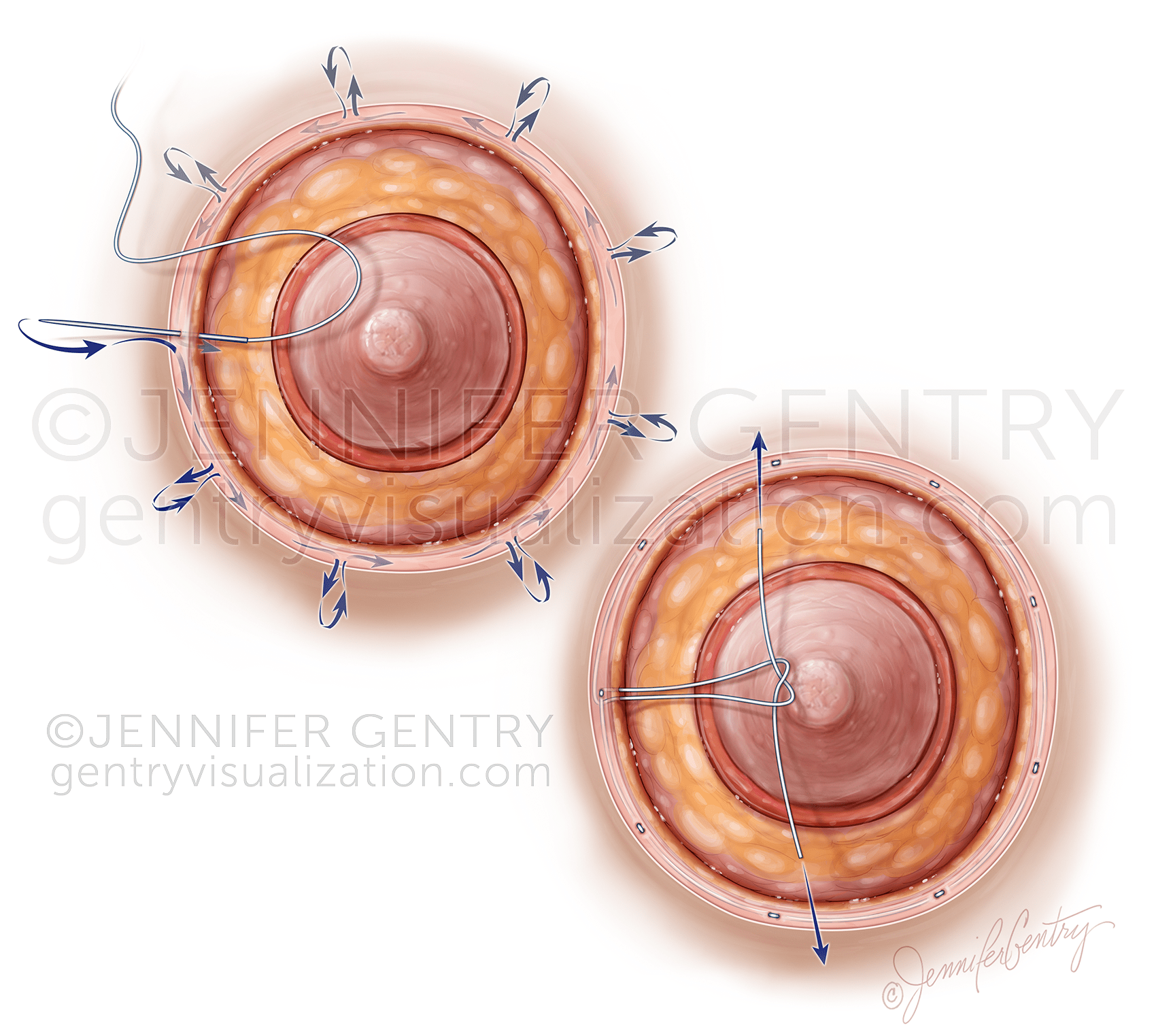 Purse String Areolaplasty