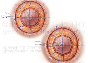 Wagon Wheel Areolaplasty