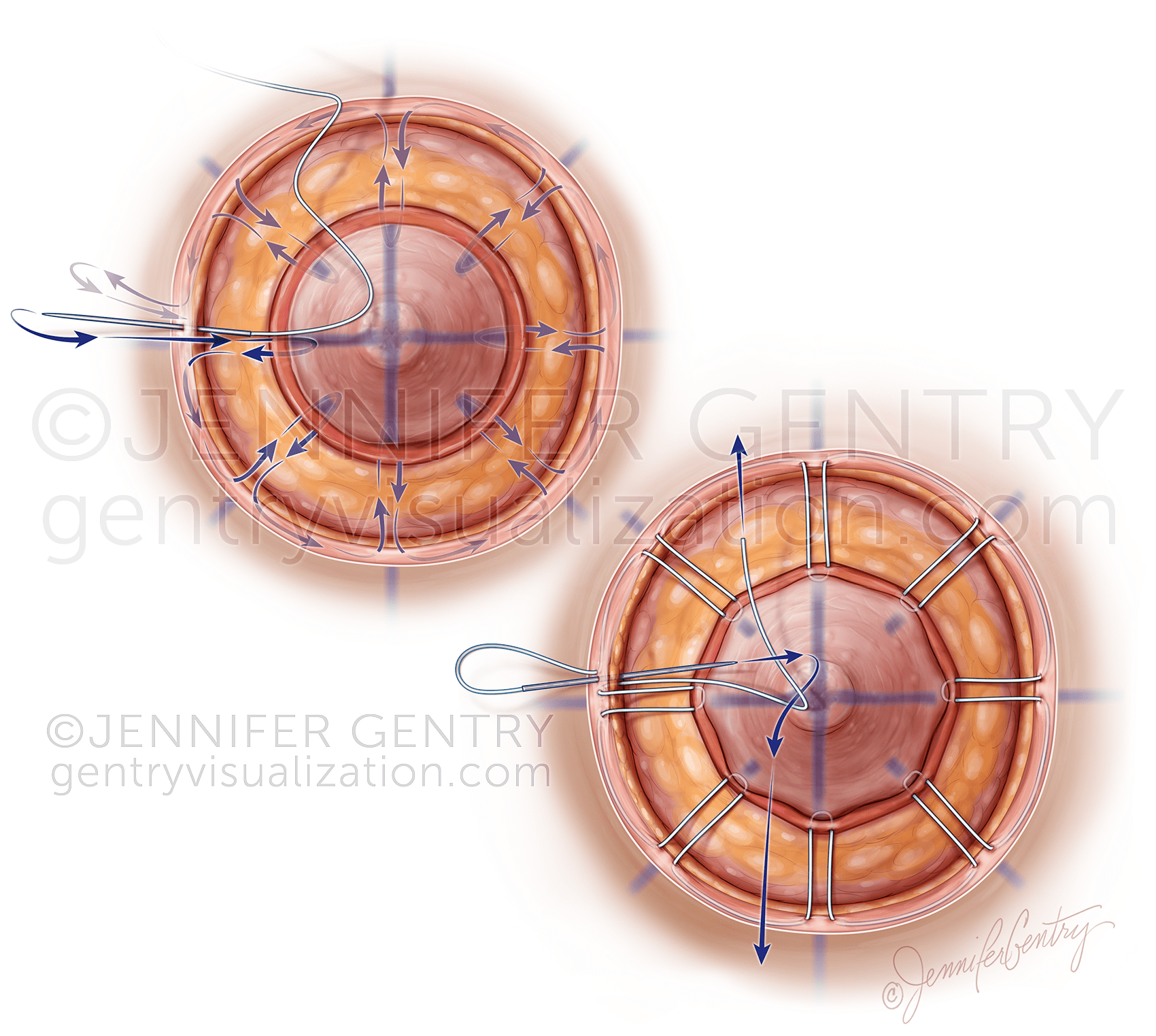 Wagon Wheel Areolaplasty