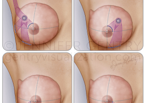 Oncoplastic Incisions