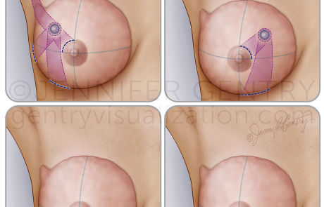 Oncoplastic Incisions