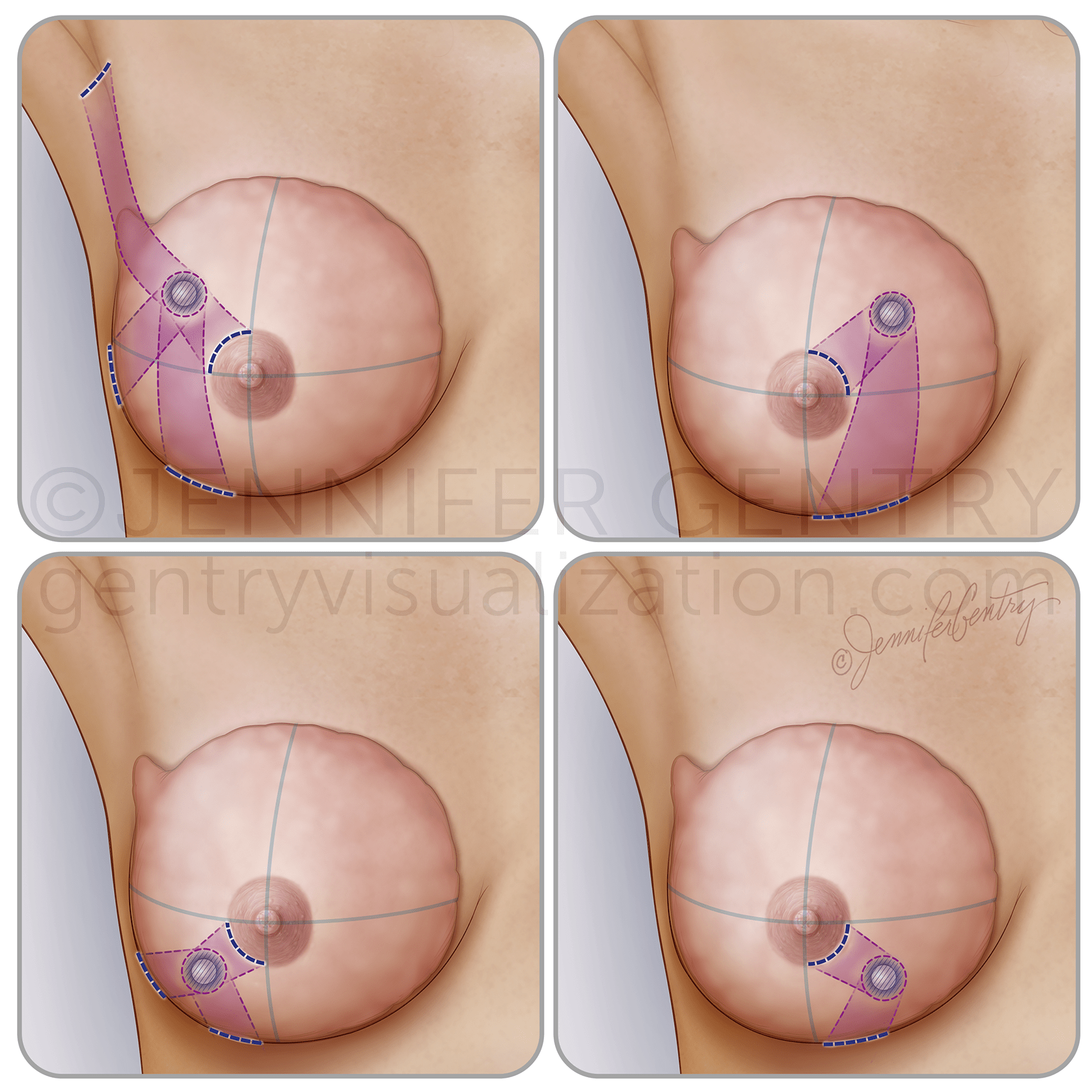 Oncoplastic Incisions