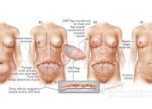 DIEP Flap Breast Reconstruction (Deep Inferior Epigastric Artery Perforator)