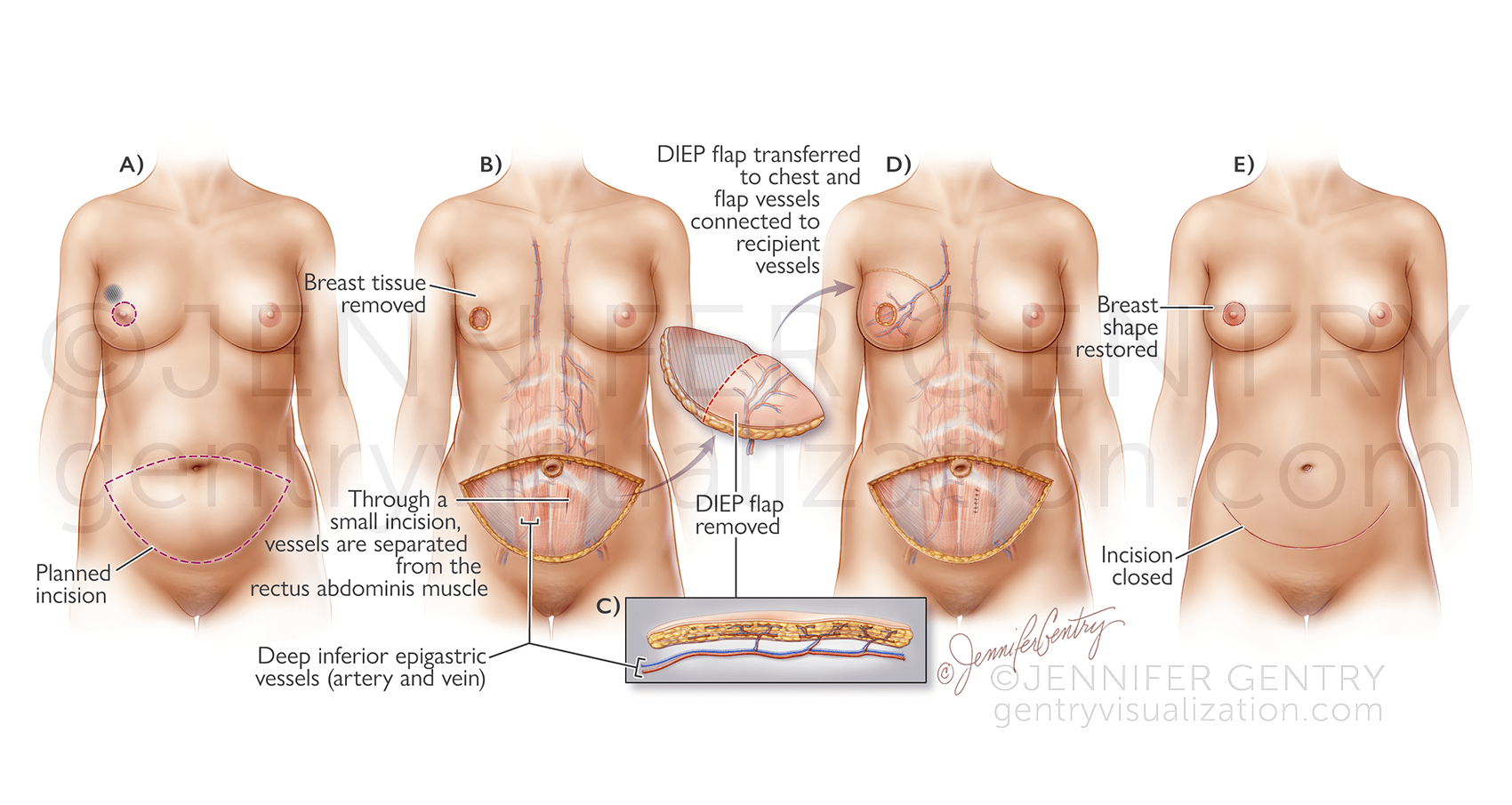 DIEP Flap Breast Reconstruction (Deep Inferior Epigastric Artery Perforator)