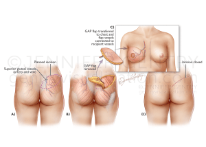 GAP Flap Breast Reconstruction (Gluteal Artery Perforator)