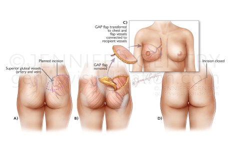 GAP Flap Breast Reconstruction (Gluteal Artery Perforator)