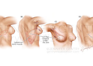 Latissimus Dorsi Flap Breast Reconstruction