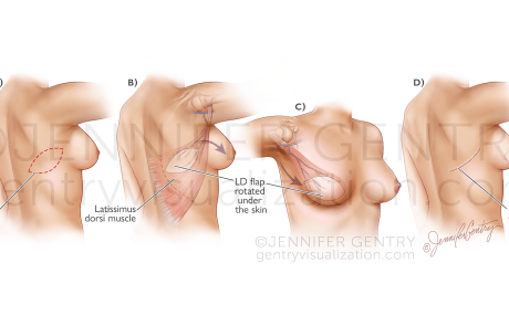 Latissimus Dorsi Flap Breast Reconstruction