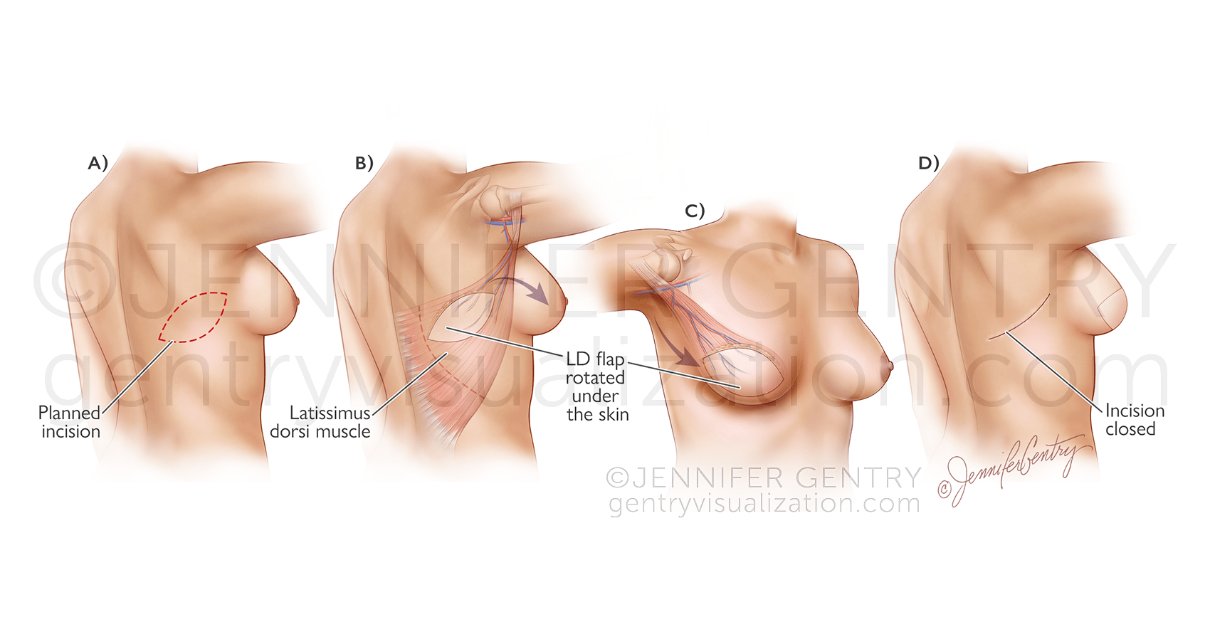 Latissimus Dorsi Flap Breast Reconstruction