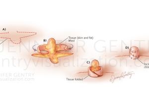 Nipple Reconstruction