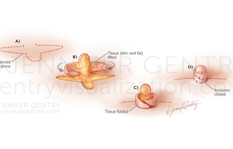 Nipple Reconstruction