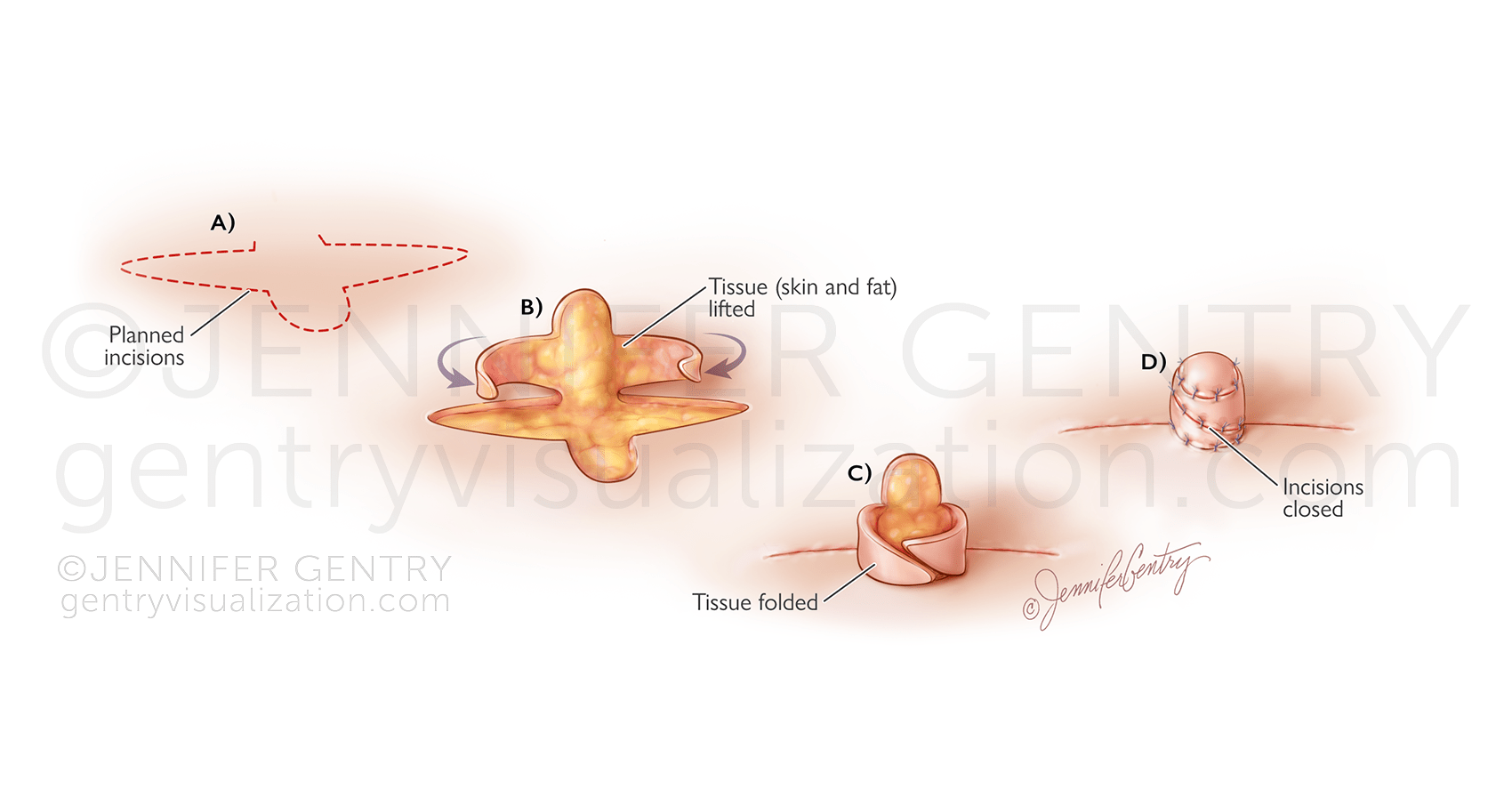 Nipple Reconstruction