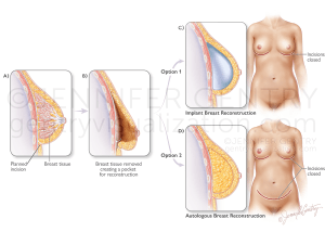 Prepectoral and Subpectoral Implant Procedure using Tissue Expander