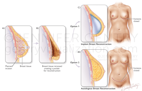 Prepectoral and Subpectoral Implant Procedure using Tissue Expander