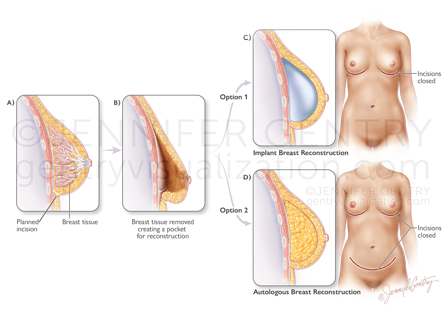 Prepectoral and Subpectoral Implant Procedure using Tissue Expander