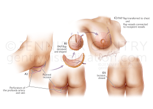 PAP Flap Procedure Breast Reconstruction (Profunda Artery Perforator)