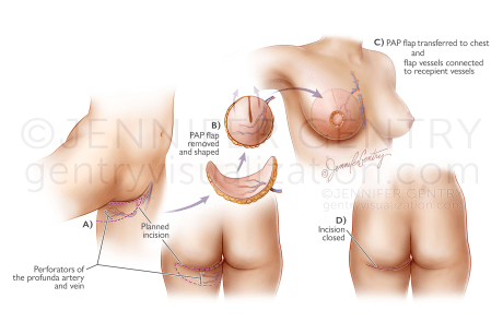 PAP Flap Procedure Breast Reconstruction (Profunda Artery Perforator)