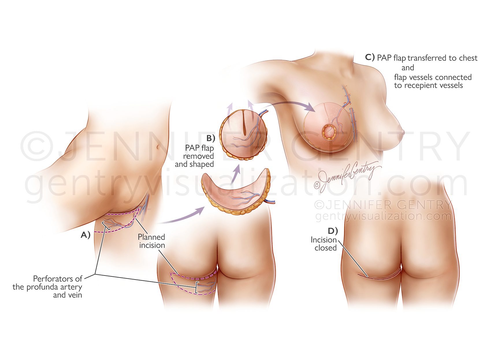 PAP Flap Procedure Breast Reconstruction (Profunda Artery Perforator)