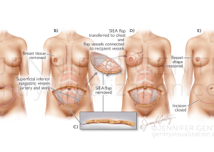 SIEA Flap Breast Reconstruction (Superficial Inferior Epigastric Artery)