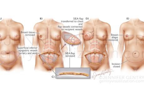 SIEA Flap Breast Reconstruction (Superficial Inferior Epigastric Artery)