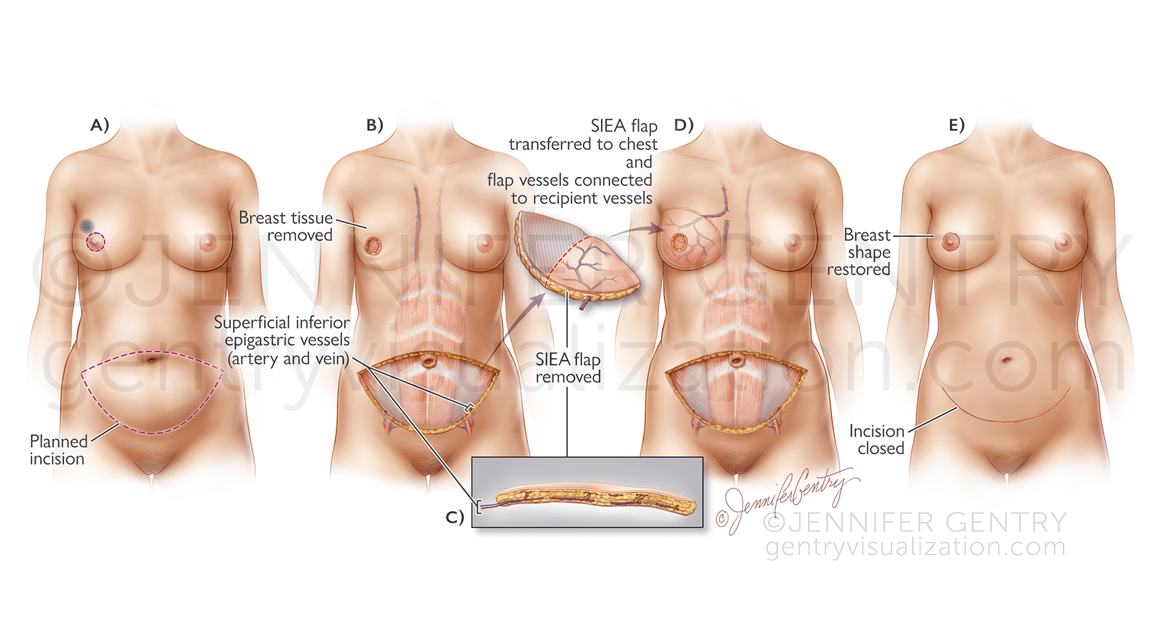 SIEA Flap Breast Reconstruction (Superficial Inferior Epigastric Artery)