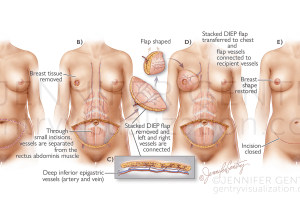 Stacked DIEP Flap Breast Reconstruction (Stacked Deep Inferior Epigastric Artery Perforator)