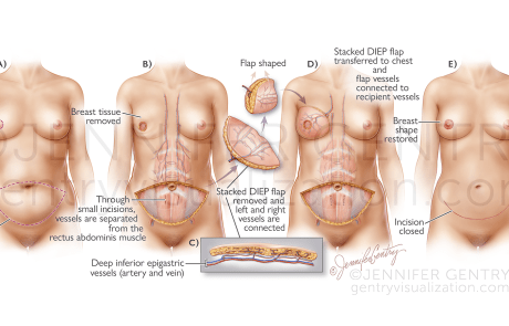 Stacked DIEP Flap Breast Reconstruction (Stacked Deep Inferior Epigastric Artery Perforator)