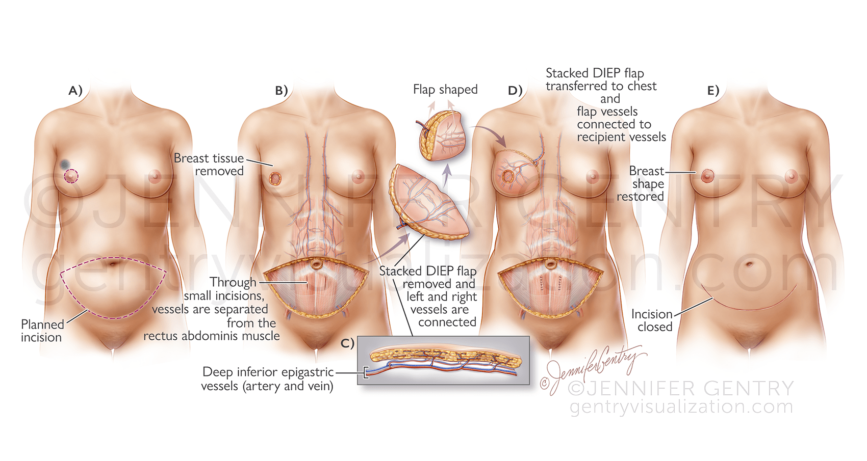 Stacked DIEP Flap Breast Reconstruction (Stacked Deep Inferior Epigastric Artery Perforator)