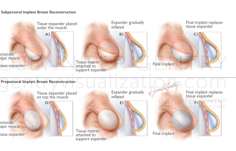 Prepectoral and Subpectoral Implant Procedure using Tissue Expander