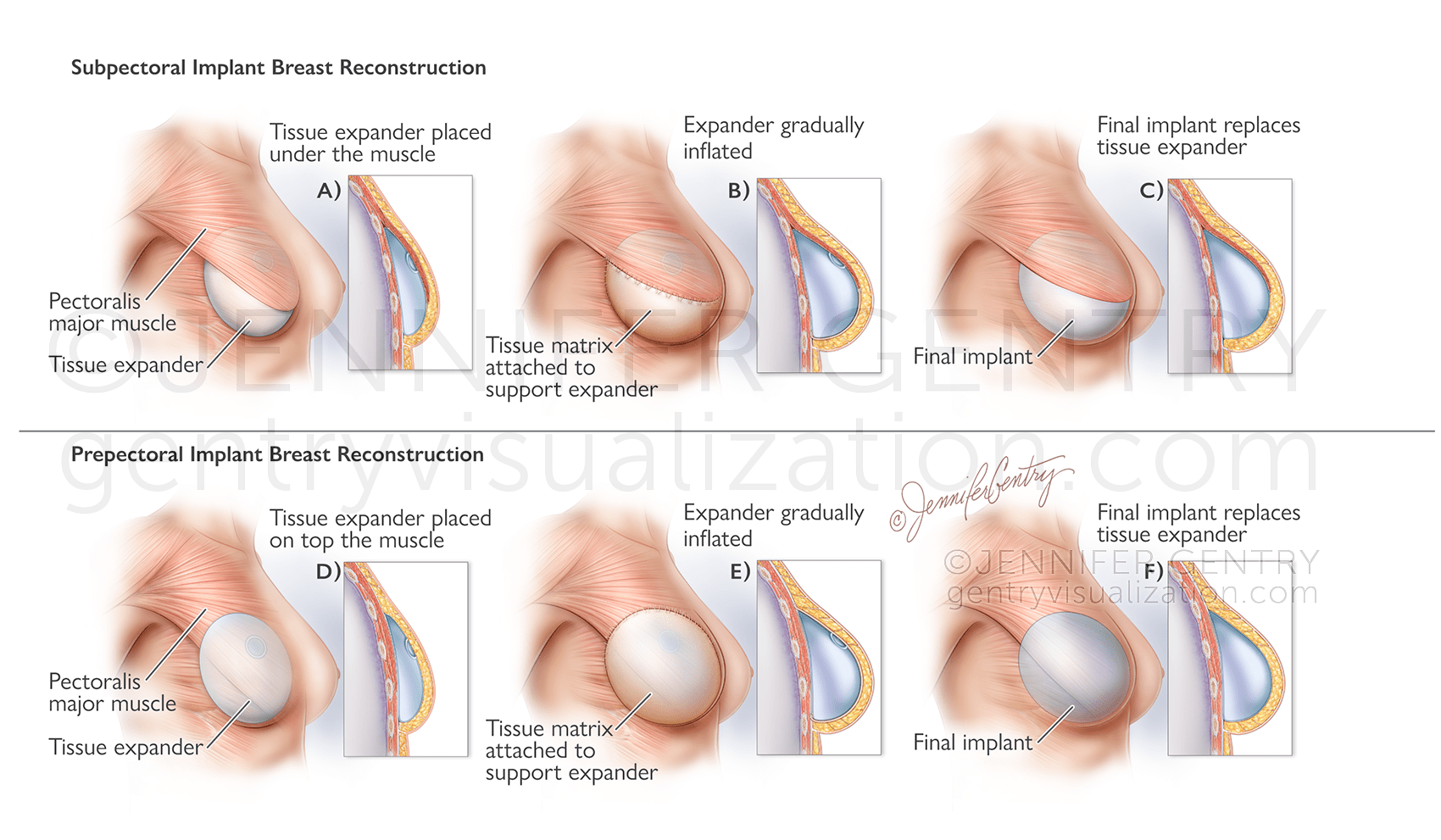 Prepectoral and Subpectoral Implant Procedure using Tissue Expander