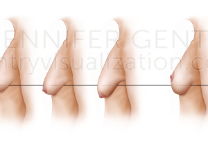 Regnault's Classification of Ptosis