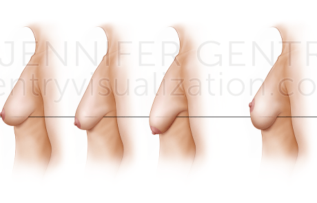 Regnault's Classification of Ptosis