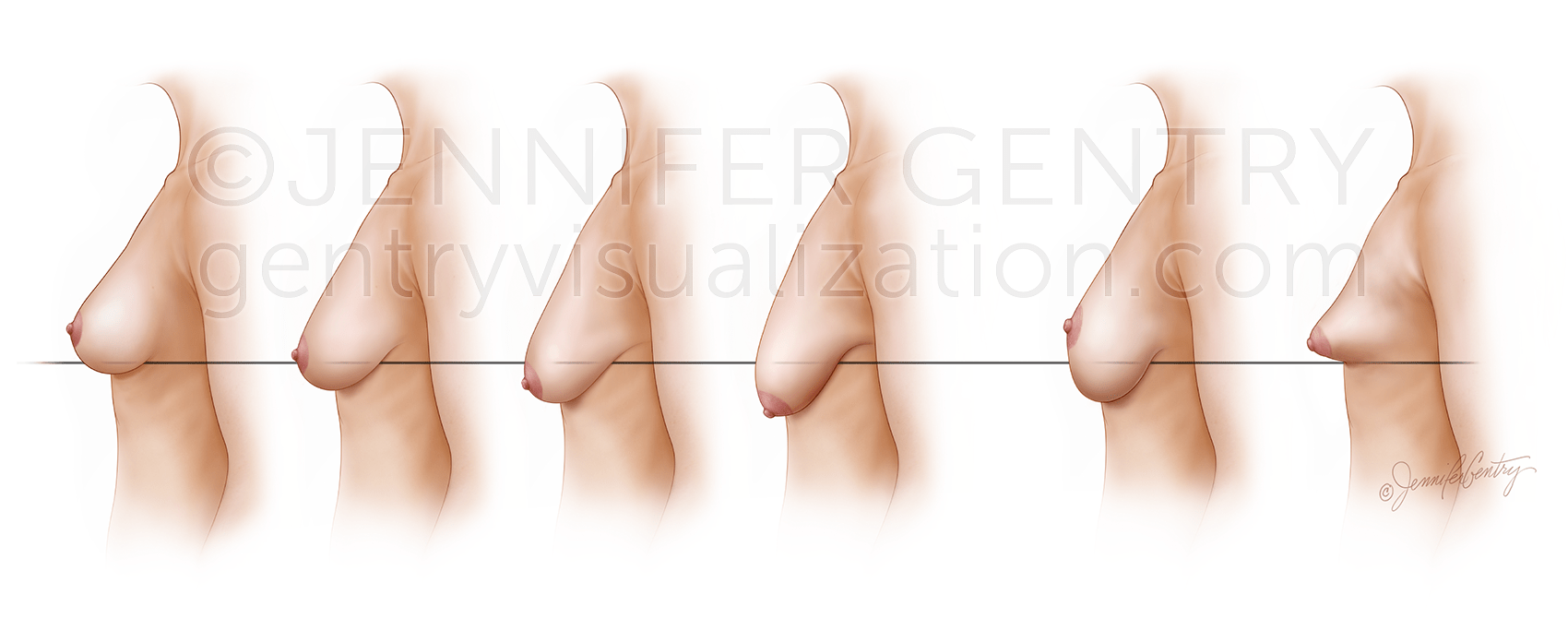 Regnault's Classification of Ptosis